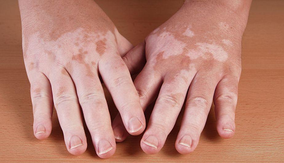 El vitiligo: causas, detección y tratamiento